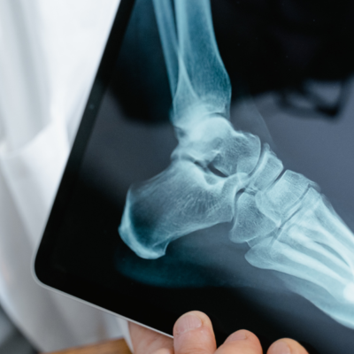 Foot xray on tablet computer